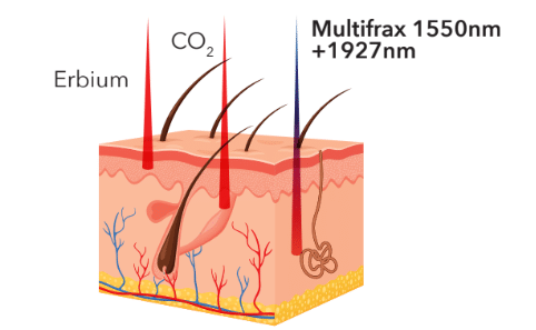 Multifrax - Digital Laser Peel (Dual Wavelength Technology)