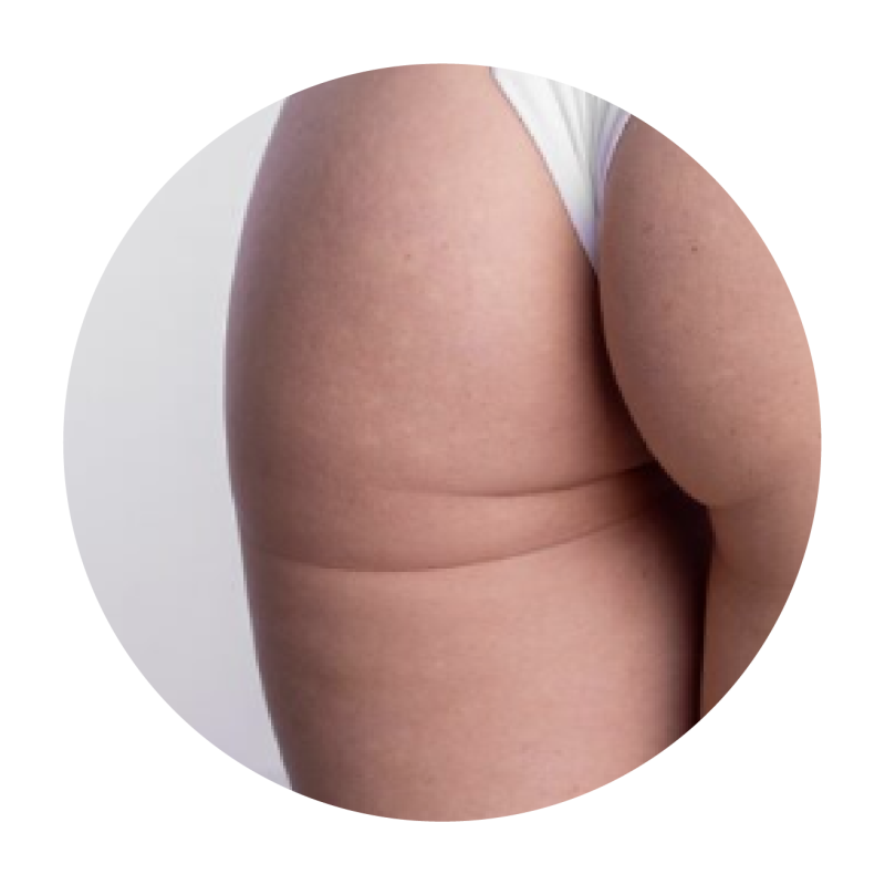 Coolsculpting Elite Singapore