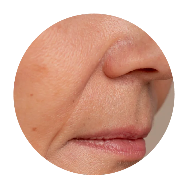 Dermal Fillers for the Nose, Chin and Face