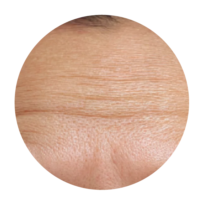 Dermal Fillers for the Nose, Chin and Face
