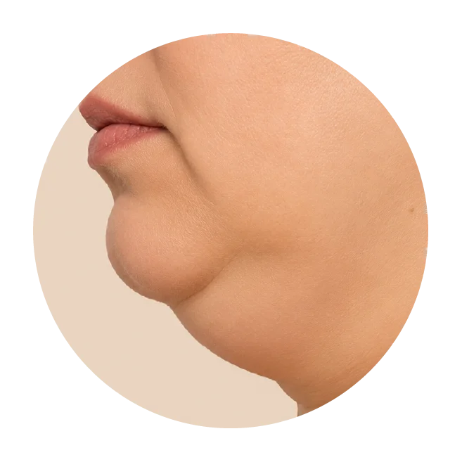 HIFU Plus Non invasive Facelift