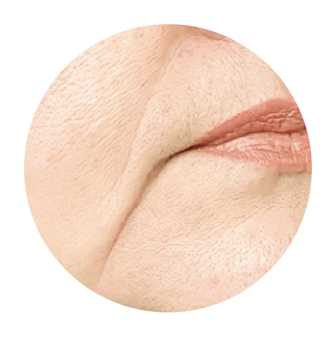 Ligament Lifting Treatment in Singapore