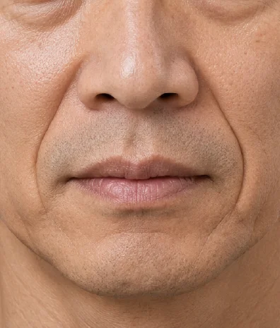 Ligament Lifting Treatment in Singapore